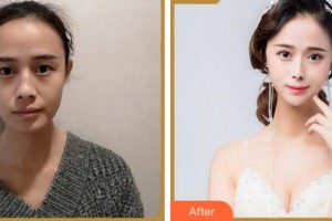 溫州醫(yī)科大學(xué)附屬眼視光醫(yī)院吳文燦整形價(jià)格表附眼部綜合案例展示