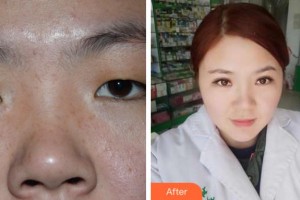 溫州醫(yī)科大學(xué)附屬眼視光醫(yī)院傅映暉整形價(jià)格表附眼部綜合案例展示