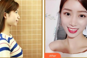 溫州醫(yī)科大學(xué)附屬眼視光醫(yī)院溫淑梅整形價(jià)格表附眼鼻多項(xiàng)案例展示