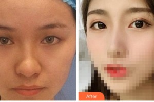 溫州醫(yī)科大學(xué)附屬眼視光醫(yī)院李軍花整形價(jià)格表附切開雙眼皮案例展示