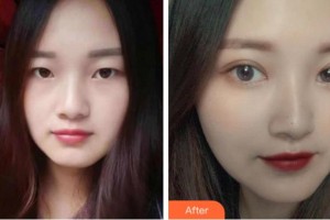 溫州醫(yī)科大學(xué)附屬眼視光醫(yī)院侯立杰整形價(jià)格表附切開雙眼皮案例展示