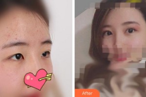 溫州醫(yī)科大學(xué)附屬眼視光醫(yī)院陳亦棋整形價(jià)格表附切開雙眼皮案例展示