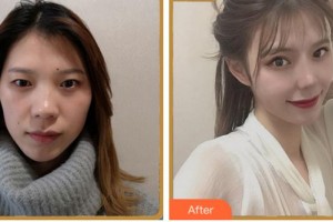 溫州醫(yī)科大學(xué)附屬眼視光醫(yī)院包芳軍整形價(jià)格表附眼部綜合案例展示