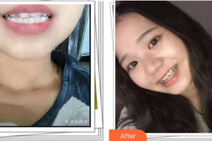 溫州拜博口腔醫(yī)院高振華整形價(jià)格表附冷光美白案例展示