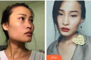 嘉興市曙光中西醫(yī)結(jié)合醫(yī)院整形美容科高峻整形價(jià)格表附切開雙眼皮案例展示