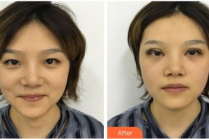 嘉興華山醫(yī)療美容醫(yī)院冉曉娟整形價(jià)格表附開內(nèi)眼角案例展示