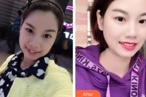 嘉興華山醫(yī)療美容醫(yī)院藍(lán)圓育整形價(jià)格表附金屬托槽矯正案例展示