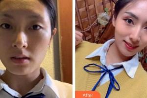 嘉興禾美醫(yī)療美容醫(yī)院柳軍整形價(jià)格表附埋線提升案例展示