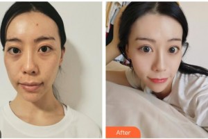 嘉興禾美醫(yī)療美容醫(yī)院趙學(xué)燕整形價(jià)格表附埋線提升案例展示