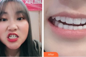 嘉興藝星醫(yī)療美容醫(yī)院陶斯靜整形價(jià)格表附牙貼面案例展示