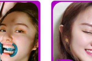 嘉興牙博士口腔門診部郭菲整形價(jià)格表附美白劑美白牙齒案例展示