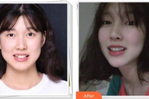 嘉興嘉誠口腔醫(yī)院吳雪琪整形價(jià)格表附牙齒隱形矯正案例展示