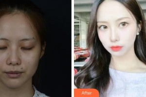 嘉興市中醫(yī)醫(yī)院眼科余其智整形價(jià)格表附埋線雙眼皮案例展示