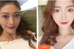 嘉興市中醫(yī)醫(yī)院眼科朱永唯整形價(jià)格表附眼部綜合案例展示