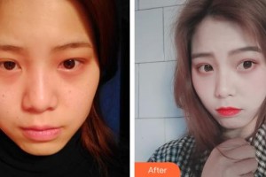 湖州曙光醫(yī)療美容門診部羅敏整形價(jià)格表附激光祛斑案例展示