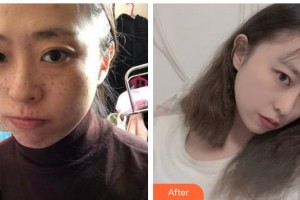 湖州曙光醫(yī)療美容門診部李玲整形價(jià)格表附激光祛斑案例展示