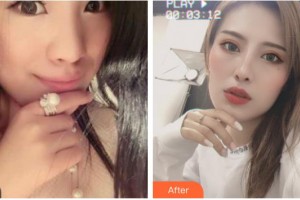 湖州長(zhǎng)興愛爾眼科醫(yī)院童峰峰整形價(jià)格表附眼部綜合案例展示