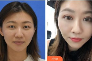 湖州長(zhǎng)興愛爾眼科醫(yī)院趙英杰整形價(jià)格表附定點(diǎn)雙眼皮案例展示