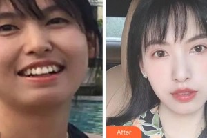 湖州金鉑利口腔門診部郭振中整形價(jià)格表附金屬托槽矯正案例展示