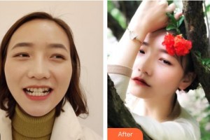 湖州金鉑利口腔門診部宋園整形價(jià)格表附牙齒隱形矯正案例展示