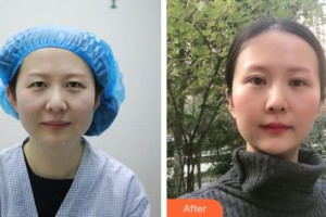 湖州星范林華醫(yī)療美容診所陳武林整形價(jià)格表附切開雙眼皮案例展示