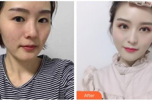 湖州愛爾眼科醫(yī)院褚任遠(yuǎn)整形價(jià)格表附切開雙眼皮案例展示