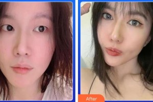 湖州愛爾眼科醫(yī)院閔偉峰整形價(jià)格表附眼部綜合案例展示