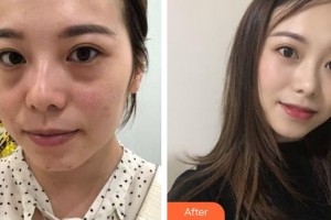 湖州愛爾眼科醫(yī)院秦士英整形價(jià)格表附激光去眼袋案例展示