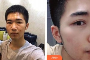 湖州愛爾眼科醫(yī)院褚惠英整形價(jià)格表附內(nèi)切祛眼袋案例展示