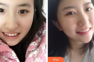 湖州鼎植口腔醫(yī)院修浩然整形價(jià)格表附牙齒隱形矯正案例展示