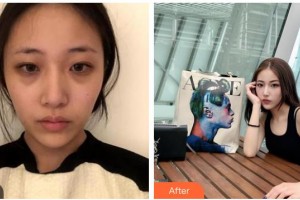 湖州長興愛爾眼科醫(yī)院周曉紅整形價格表附內(nèi)切祛眼袋案例展示