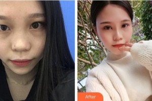 湖州長興愛爾眼科醫(yī)院金志華整形價格表附定點(diǎn)雙眼皮案例展示