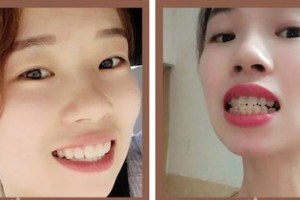 湖州陳景康牙科診所朱雙龍整形價格表附牙齒隱形矯正案例展示