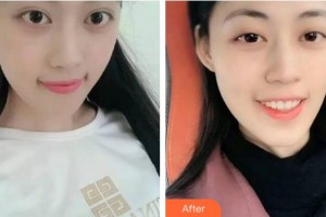 湖州鼎植口腔醫(yī)院聞香禎整形價格表附冷光美白案例展示