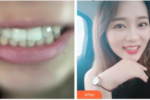 湖州徐兆桂牙科診所徐強(qiáng)整形價格表附金屬托槽矯正案例展示