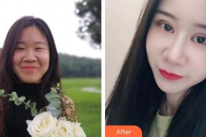 湖州市中心醫(yī)院眼科周紅整形價格表附眼部綜合案例展示