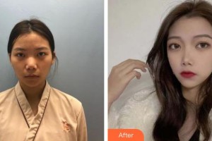 湖州市中心醫(yī)院眼科陳建康整形價格表附眼部綜合案例展示