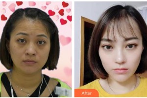 湖州市中心醫(yī)院眼科張軍輝整形價格表附激光去眼袋案例展示