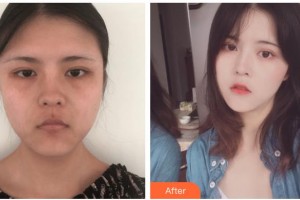 紹興華美整形美容醫(yī)院葉品英整形價格表附埋線提升案例展示