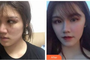 紹興華美整形美容醫(yī)院張潔整形價(jià)格表附埋線提升案例展示