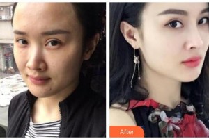 紹興華美整形美容醫(yī)院楊麗整形價(jià)格表附熱瑪吉案例展示