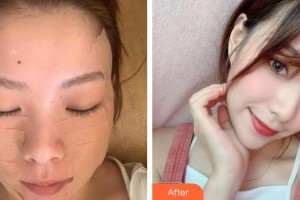 紹興市婦幼保健院醫(yī)療美容科俞國寶整形價(jià)格表附埋線提升案例展示