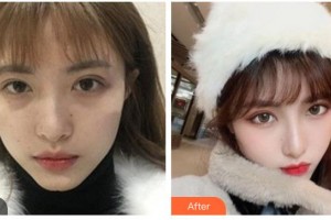 紹興施美爾整形美容醫(yī)院張科整形價(jià)格表附熱瑪吉案例展示