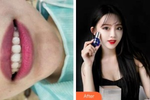 紹興華美整形美容醫(yī)院張佾科整形價(jià)格表附牙齒隱形矯正案例展示