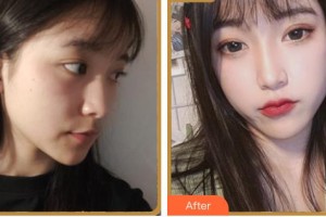 紹興華美整形美容醫(yī)院王伊萍整形價(jià)格表附埋線提升案例展示