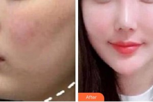 紹興華美整形美容醫(yī)院鄭志峰整形價(jià)格表附膠原蛋白除皺案例展示