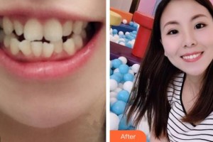 紹興市人民醫(yī)院醫(yī)療美容科王海花整形價(jià)格表附金屬托槽矯正案例展示