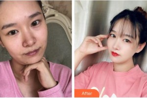 紹興市人民醫(yī)院醫(yī)療美容科陳宏整形價(jià)格表附抗衰案例展示