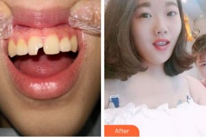 紹興越城口腔醫(yī)院王偉整形價(jià)格表附美白貼片案例展示