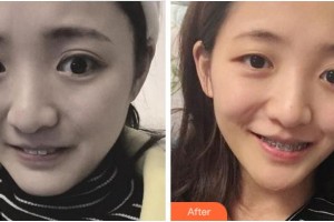 紹興柯橋口腔醫(yī)院宋閑整形價(jià)格表附金屬托槽矯正案例展示